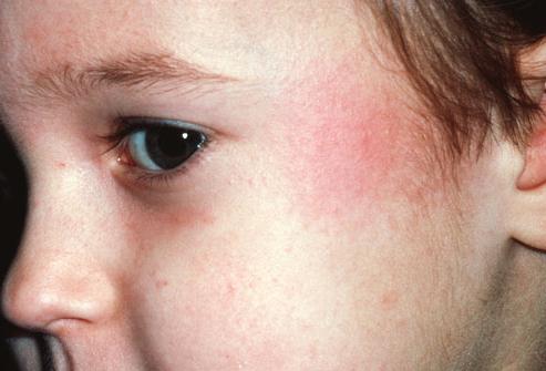Erupțiile pe fața copiilor: cauzele apariției