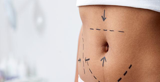 Tummy Tuck recenzii