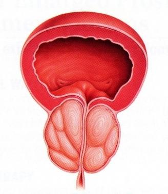 diagnosticul de adenom prostatic