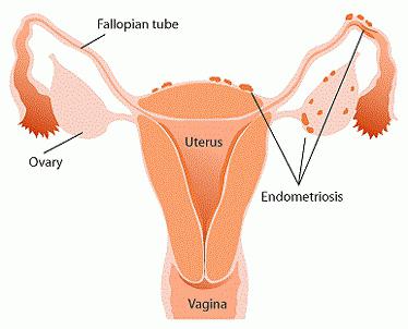 Duphaston în evaluările endometriozei