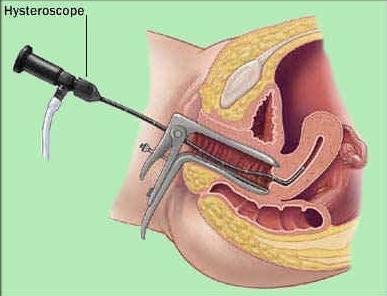 histeroscopia uterului