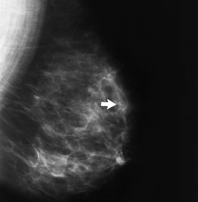 calcificarea în glanda mamară