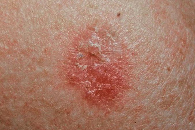 melanomul pielea preziceri revizuiri 