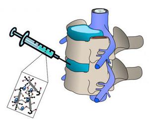 Injecții cu osteocondroză