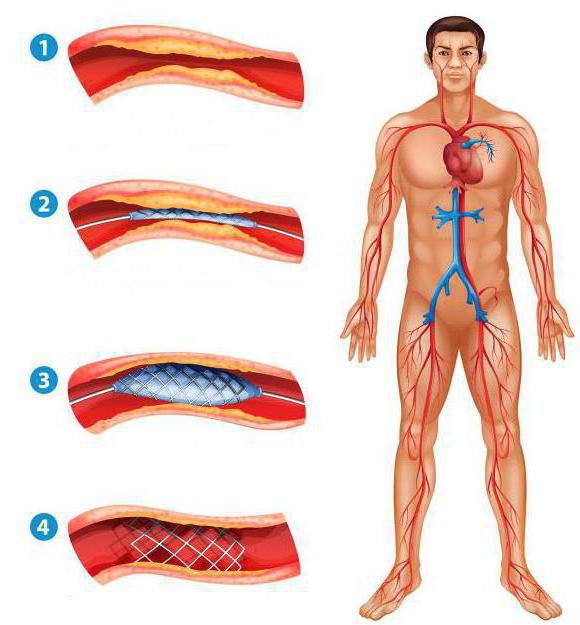 Plăgi cardiace: cauze, diagnostic și tratament