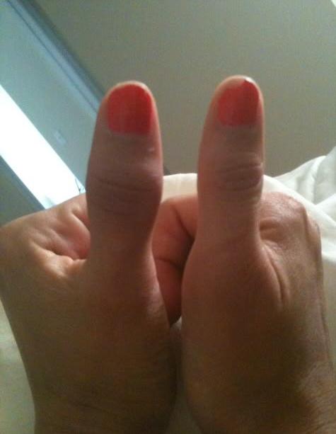 Degete degete pe mâini: cauze, diagnostic, tratament. Ce trebuie făcut dacă articulațiile de pe degete sunt umflate