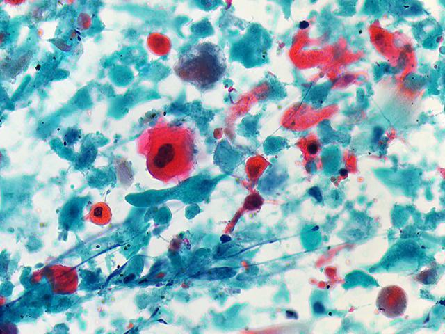 Carcinomul cu celule scuamoase a colului uterin: prognostic, tratament