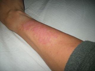 Dermatita dermatita (fotodermatoza)