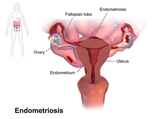 mirena în endometrioză